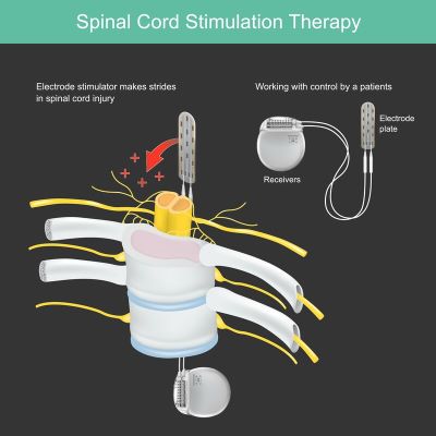 Spinal-Cord-Stimulation.jpg