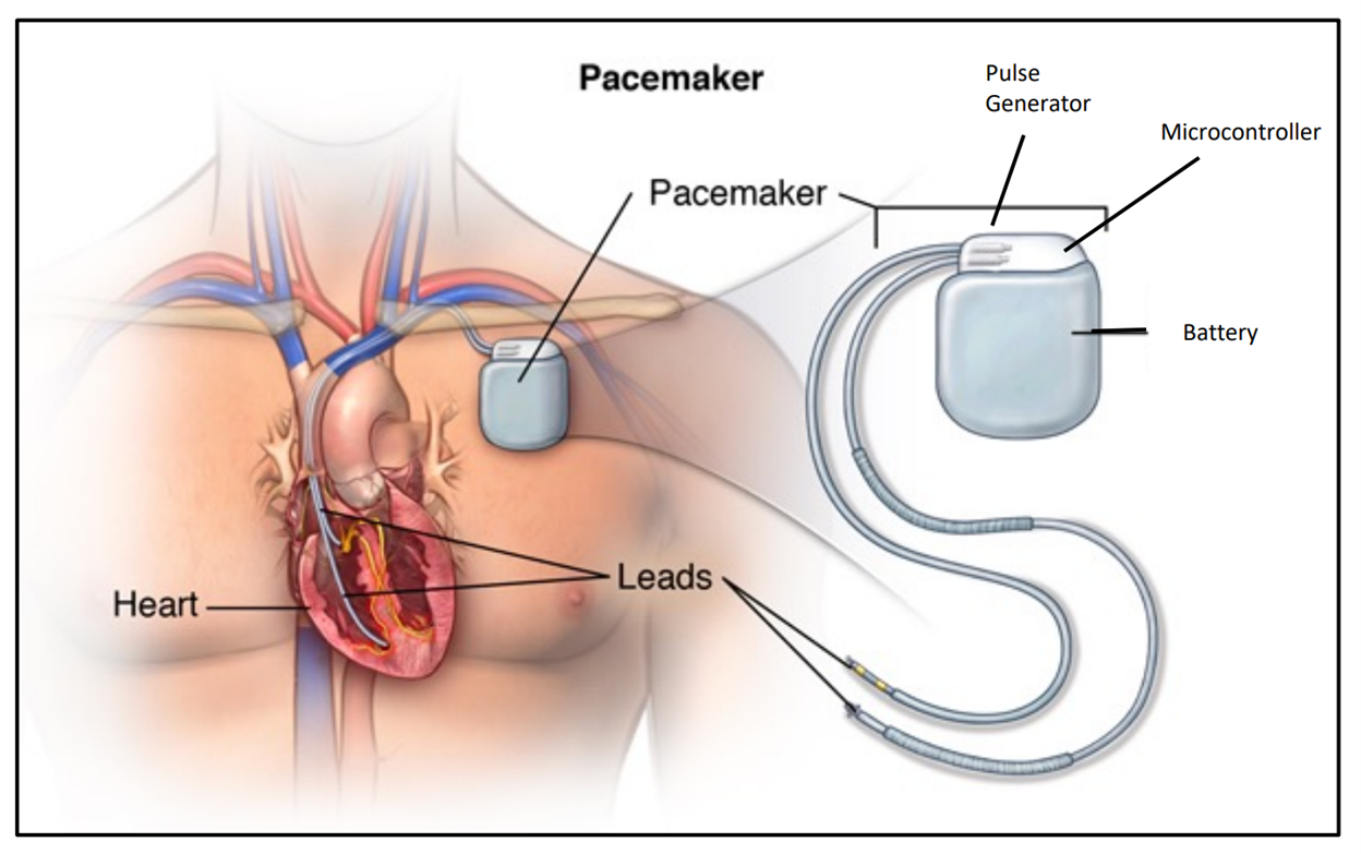 3BDES Pacemaker Reference.png